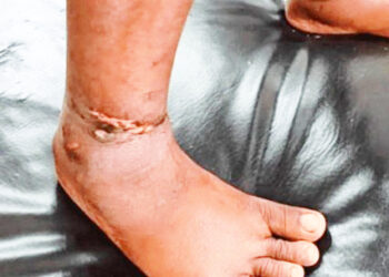 ஐந்து வயதுச் சிறுமிக்கு சூடுவைத்து சித்திரவதை!