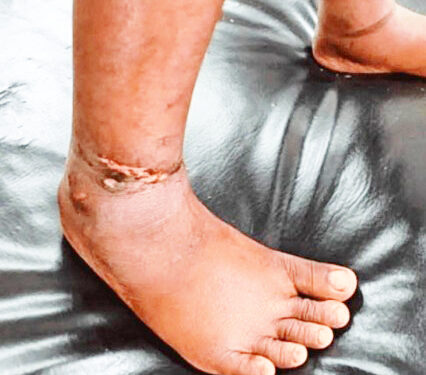 ஐந்து வயதுச் சிறுமிக்கு சூடுவைத்து சித்திரவதை!