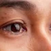 கண் தொற்றுகள் குறித்த எச்சரிக்கை!