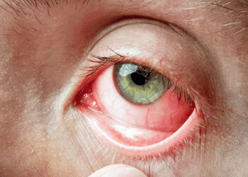 வெள்ளத்தால் பாதிக்கப்பட்டவர்களுக்கு வெண்படல நோய் பரவல் அதிகரிப்பு!