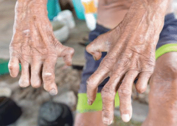 இலங்கையில் ஆண்டுக்கு 2,000 தொழு நோயாளர்கள்!