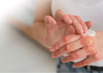 தொழுநோயாளிகளில் 10 வீதமானோர் –  பாடசாலை மாணவர்கள்!