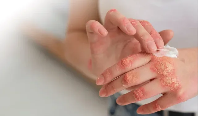 தொழுநோயாளிகளில் 10 வீதமானோர் –  பாடசாலை மாணவர்கள்!